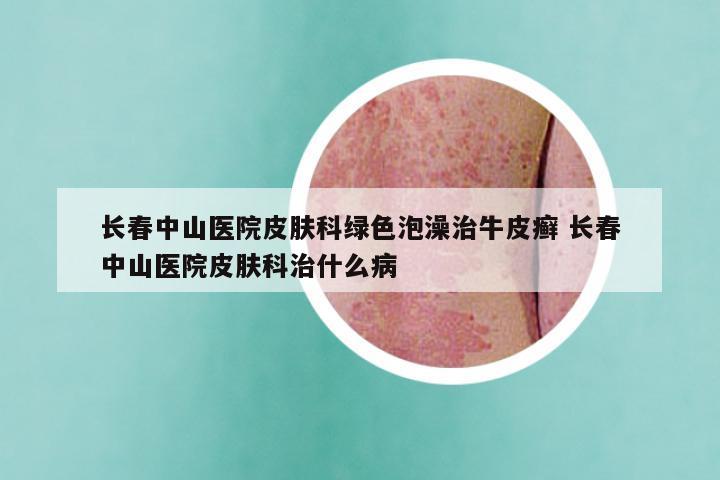 长春中山医院皮肤科绿色泡澡治牛皮癣 长春中山医院皮肤科治什么病