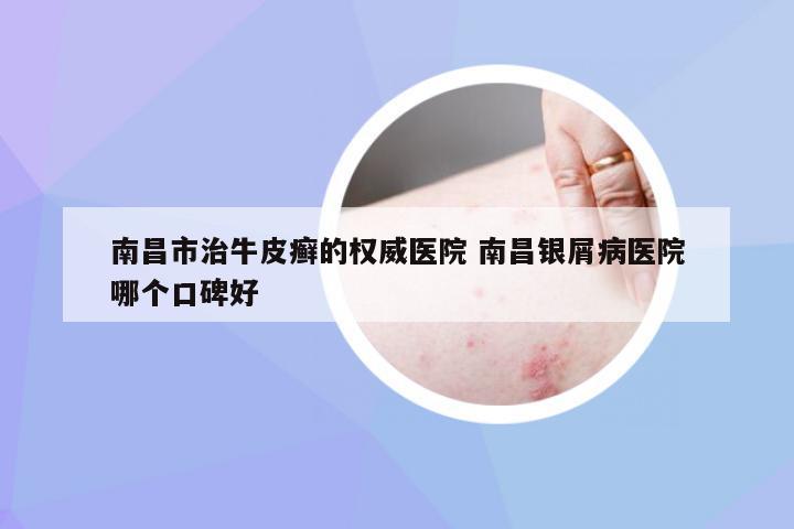 南昌市治牛皮癣的权威医院 南昌银屑病医院哪个口碑好