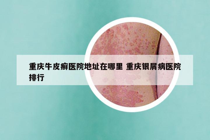 重庆牛皮癣医院地址在哪里 重庆银屑病医院排行