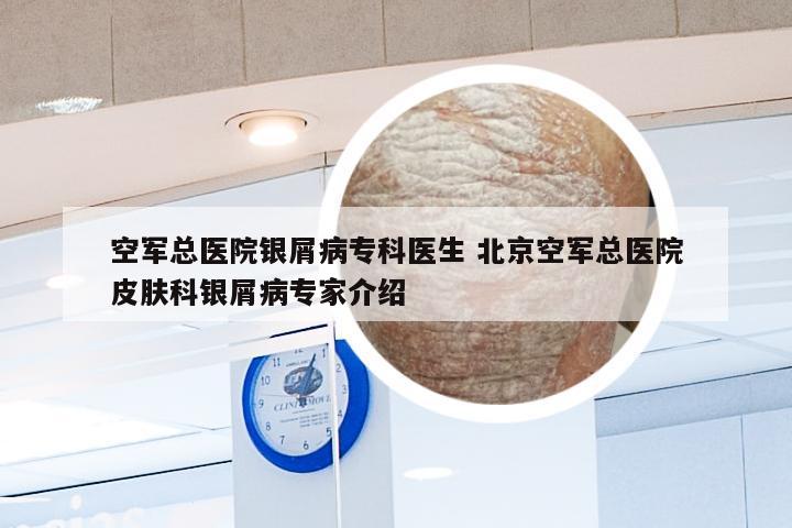 空军总医院银屑病专科医生 北京空军总医院皮肤科银屑病专家介绍
