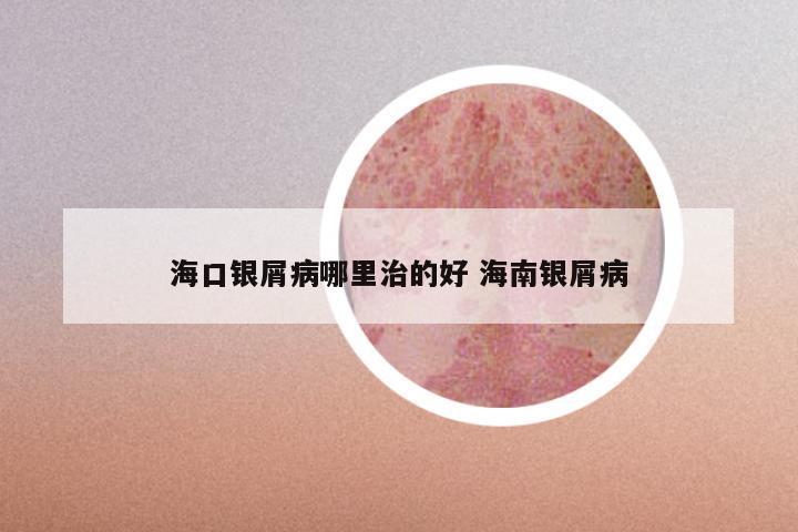 海口银屑病哪里治的好 海南银屑病