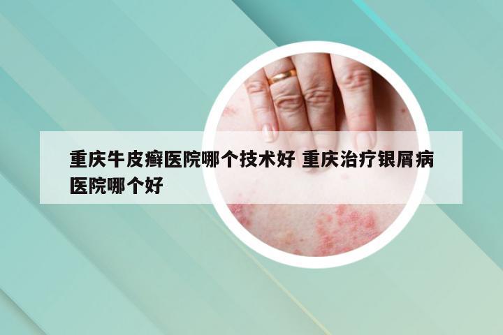 重庆牛皮癣医院哪个技术好 重庆治疗银屑病医院哪个好