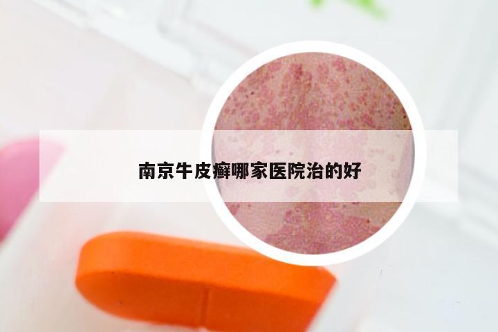 南京牛皮癣哪家医院治的好