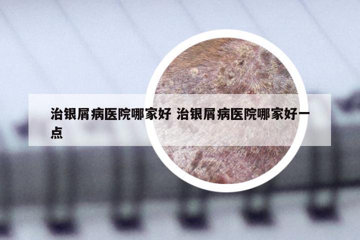 治银屑病医院哪家好 治银屑病医院哪家好一点
