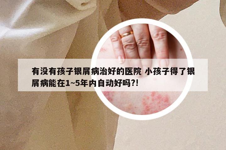 有没有孩子银屑病治好的医院 小孩子得了银屑病能在1~5年内自动好吗?!