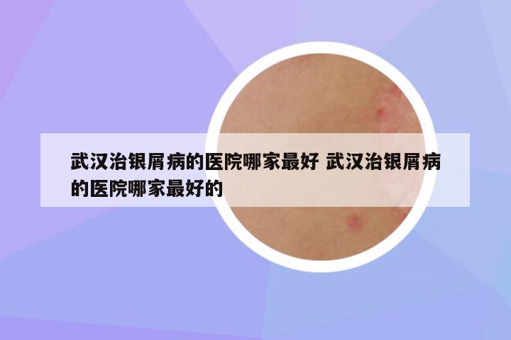 武汉治银屑病的医院哪家最好 武汉治银屑病的医院哪家最好的