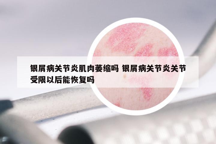 银屑病关节炎肌肉萎缩吗 银屑病关节炎关节受限以后能恢复吗