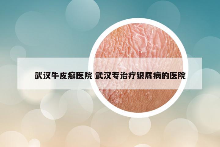 武汉牛皮癣医院 武汉专治疗银屑病的医院