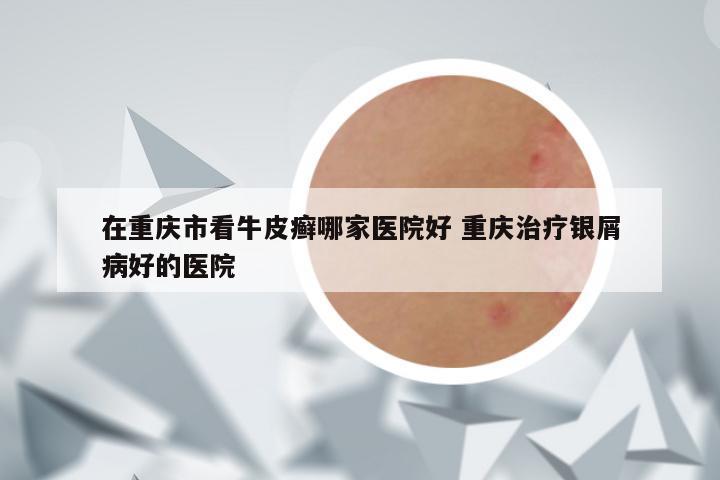 在重庆市看牛皮癣哪家医院好 重庆治疗银屑病好的医院