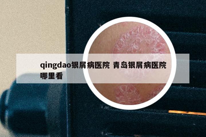 qingdao银屑病医院 青岛银屑病医院哪里看