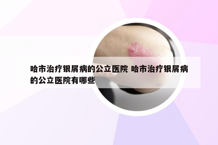 哈市治疗银屑病的公立医院 哈市治疗银屑病的公立医院有哪些