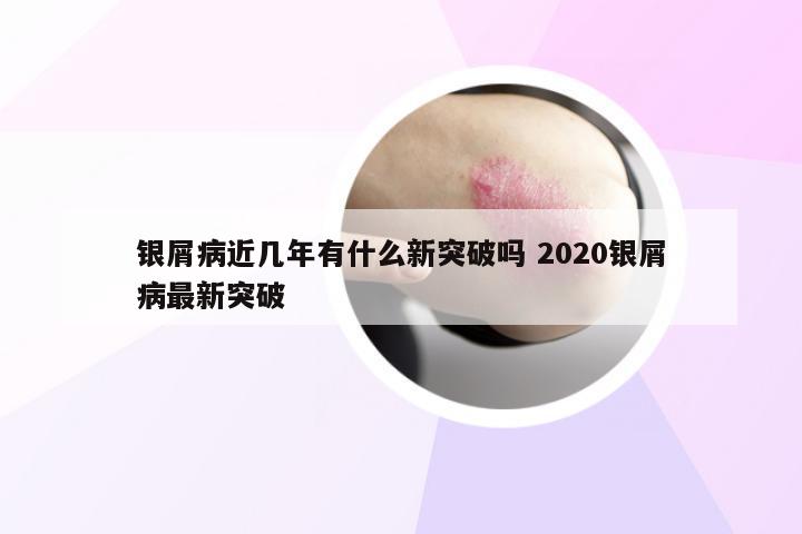 银屑病近几年有什么新突破吗 2020银屑病最新突破