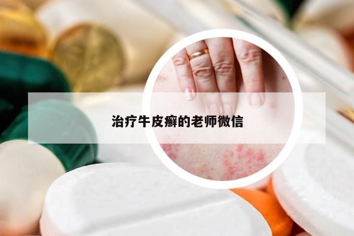 治疗牛皮癣的老师微信
