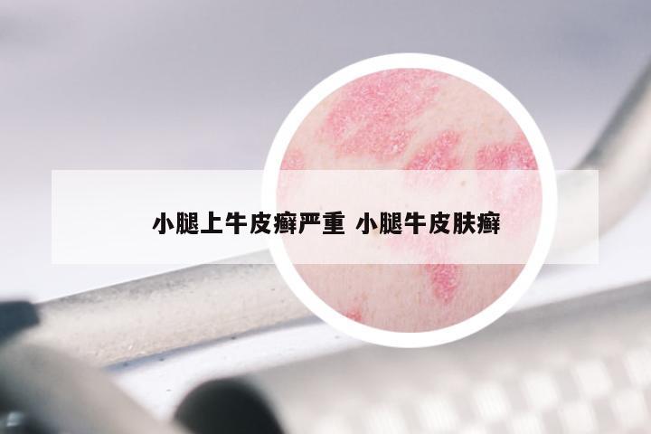 小腿上牛皮癣严重 小腿牛皮肤癣