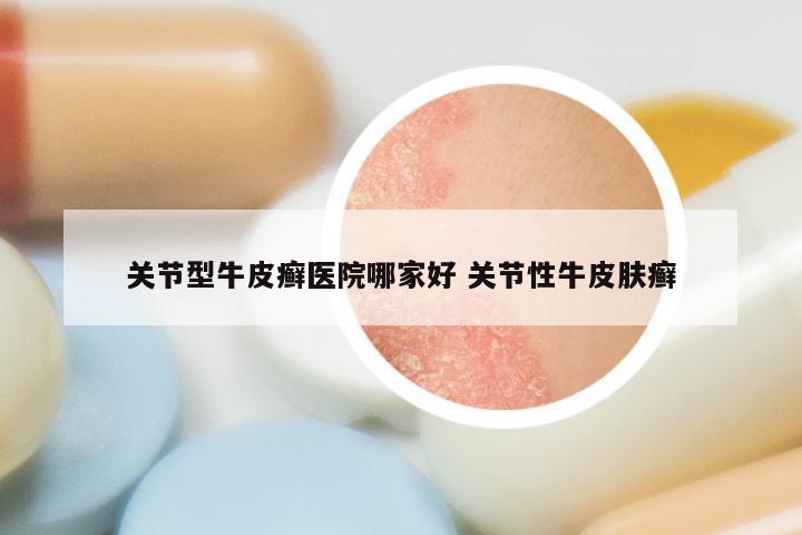 关节型牛皮癣医院哪家好 关节性牛皮肤癣