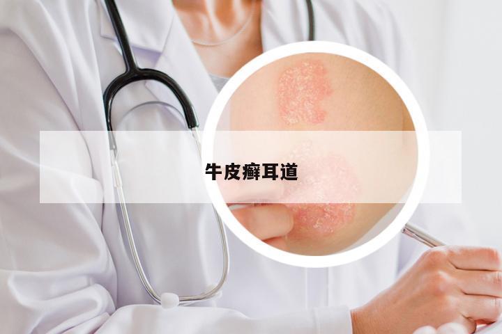 牛皮癣耳道