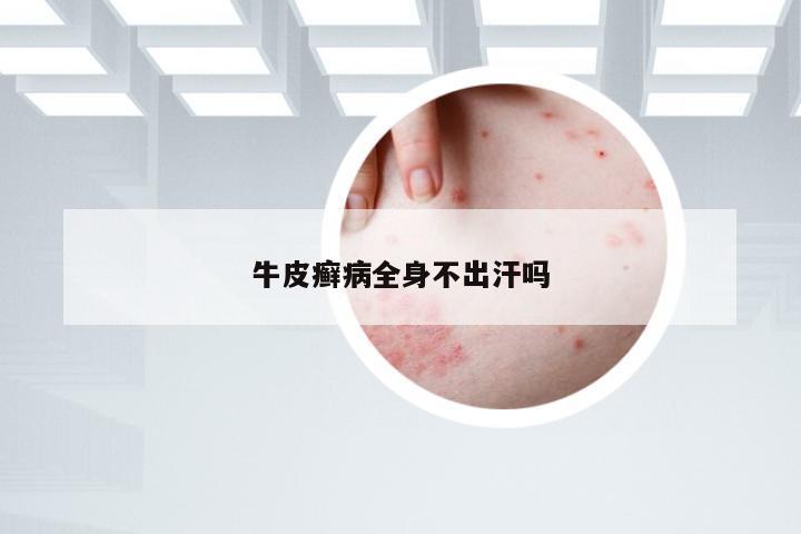 牛皮癣病全身不出汗吗