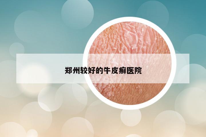 郑州较好的牛皮癣医院