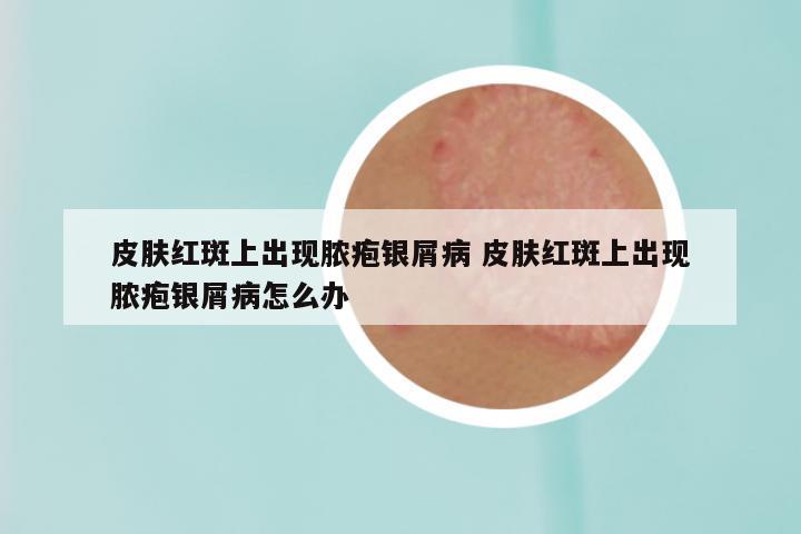 皮肤红斑上出现脓疱银屑病 皮肤红斑上出现脓疱银屑病怎么办