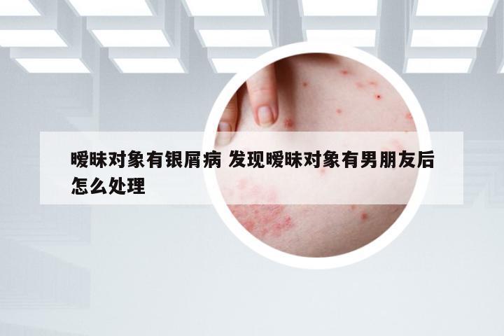 暧昧对象有银屑病 发现暧昧对象有男朋友后怎么处理