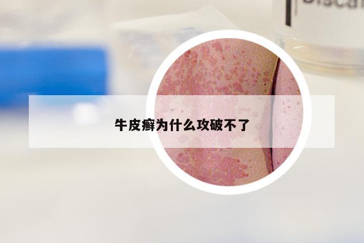 牛皮癣为什么攻破不了
