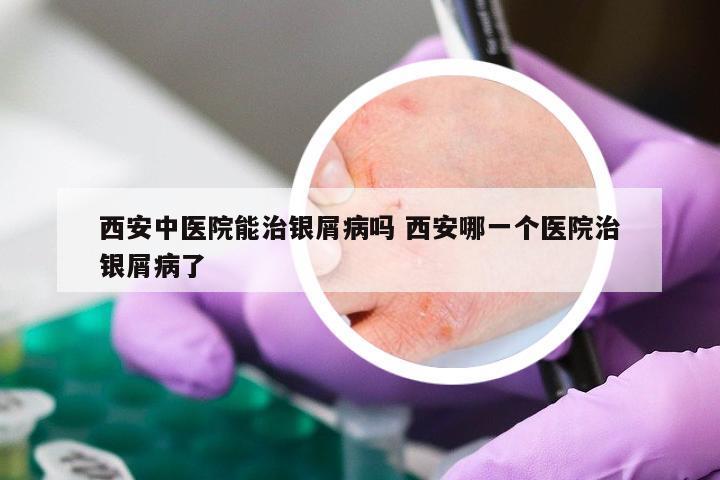 西安中医院能治银屑病吗 西安哪一个医院治银屑病了