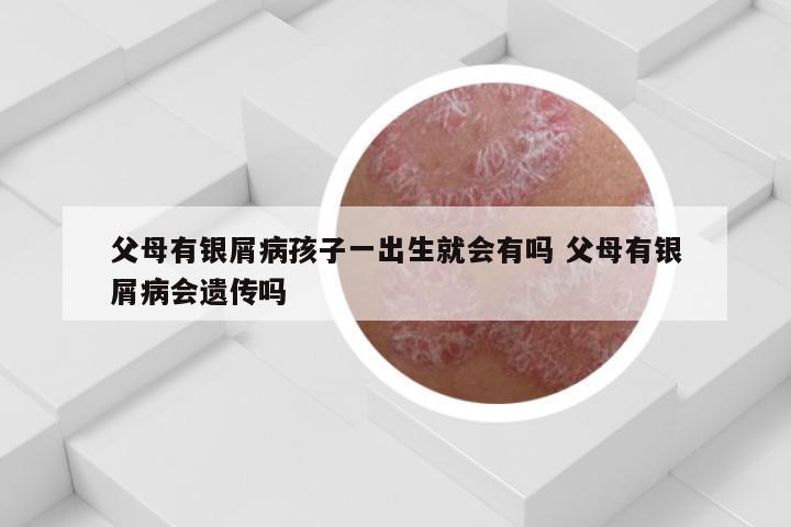 父母有银屑病孩子一出生就会有吗 父母有银屑病会遗传吗