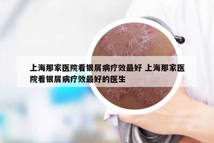 上海那家医院看银屑病疗效最好 上海那家医院看银屑病疗效最好的医生