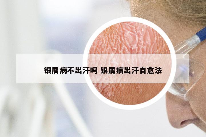 银屑病不出汗吗 银屑病出汗自愈法