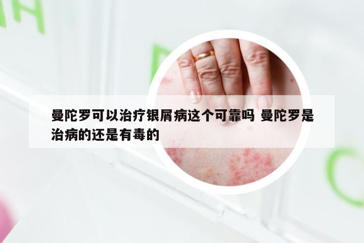 曼陀罗可以治疗银屑病这个可靠吗 曼陀罗是治病的还是有毒的