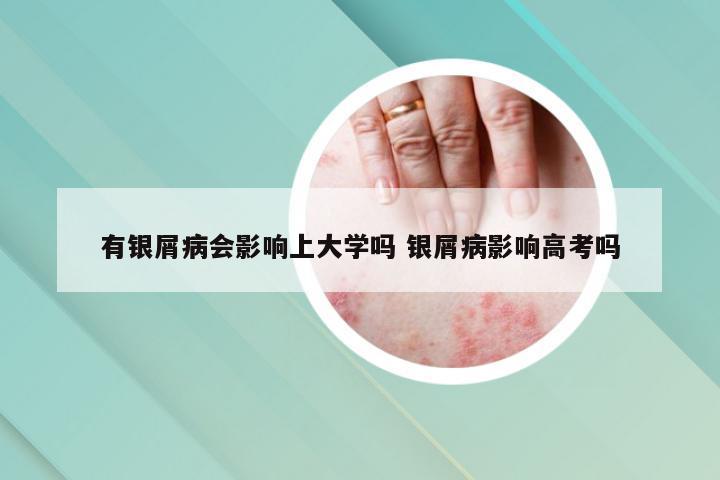 有银屑病会影响上大学吗 银屑病影响高考吗