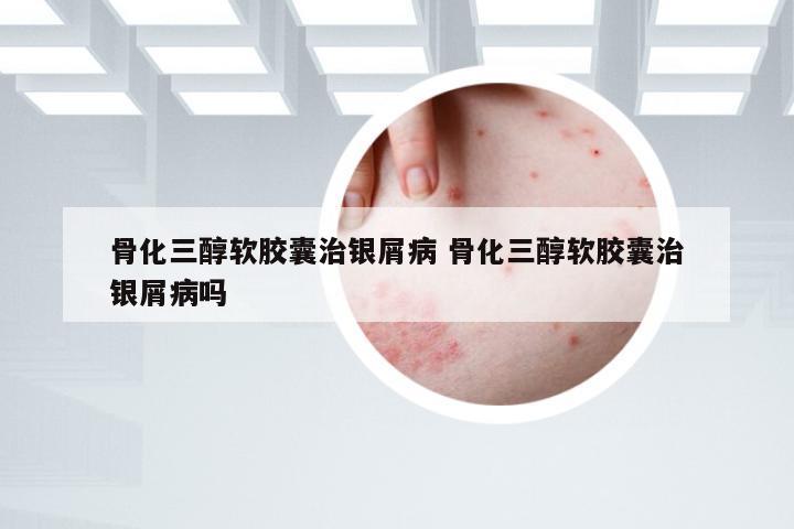 骨化三醇软胶囊治银屑病 骨化三醇软胶囊治银屑病吗
