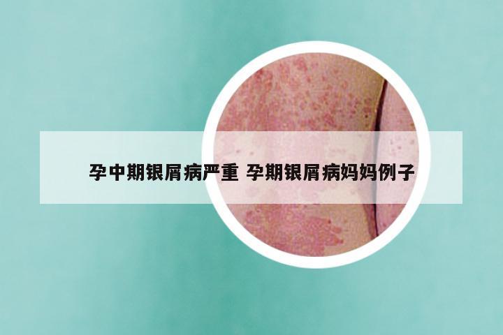 孕中期银屑病严重 孕期银屑病妈妈例子