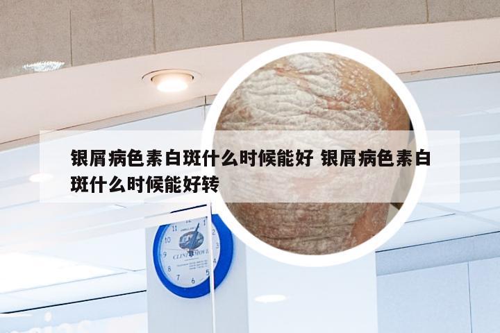 银屑病色素白斑什么时候能好 银屑病色素白斑什么时候能好转