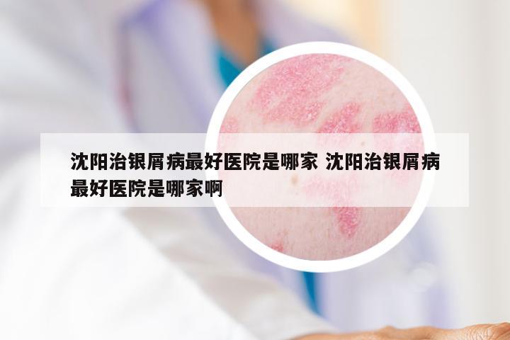 沈阳治银屑病最好医院是哪家 沈阳治银屑病最好医院是哪家啊