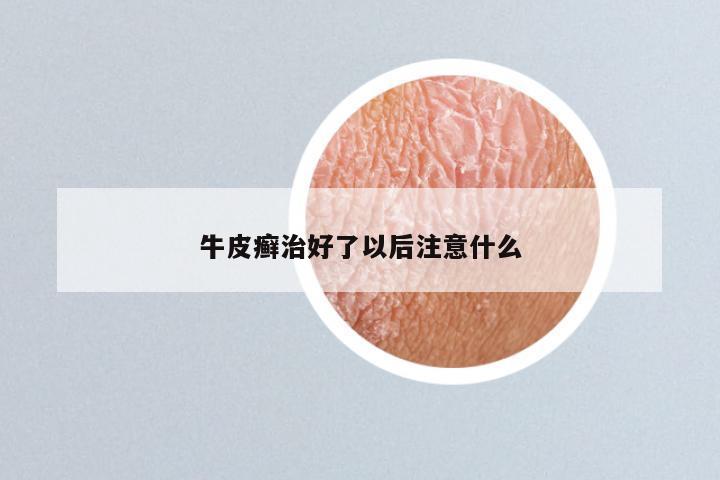 牛皮癣治好了以后注意什么