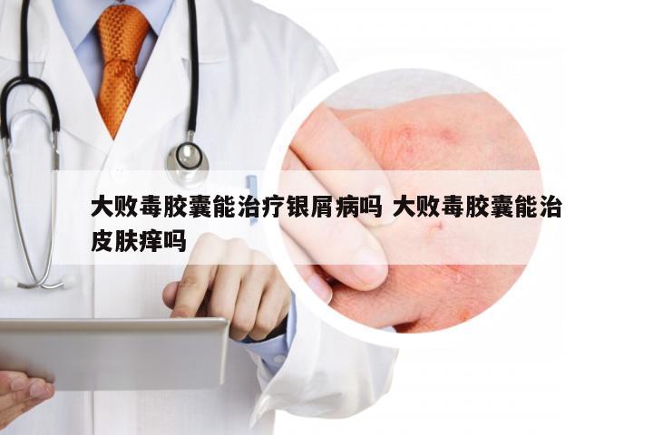 大败毒胶囊能治疗银屑病吗 大败毒胶囊能治皮肤痒吗