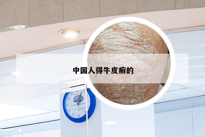 中国人得牛皮癣的