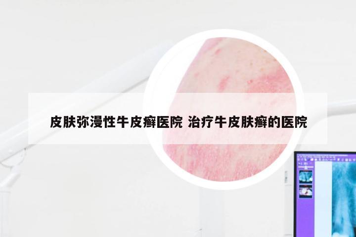 皮肤弥漫性牛皮癣医院 治疗牛皮肤癣的医院
