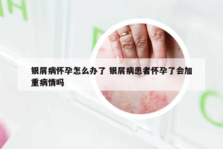 银屑病怀孕怎么办了 银屑病患者怀孕了会加重病情吗