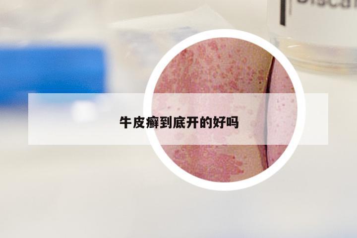 牛皮癣到底开的好吗