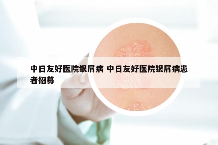 中日友好医院银屑病 中日友好医院银屑病患者招募