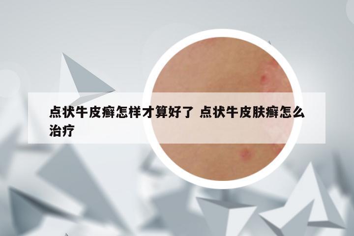 点状牛皮癣怎样才算好了 点状牛皮肤癣怎么治疗