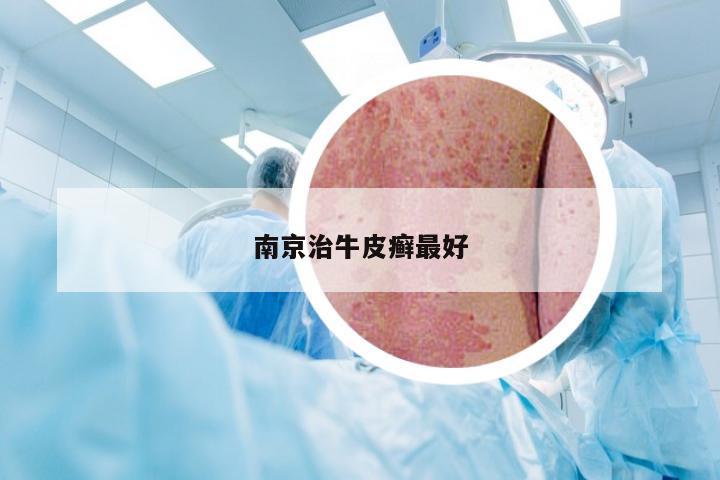 南京治牛皮癣最好