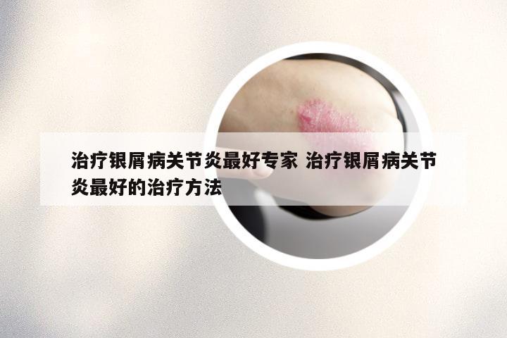 治疗银屑病关节炎最好专家 治疗银屑病关节炎最好的治疗方法