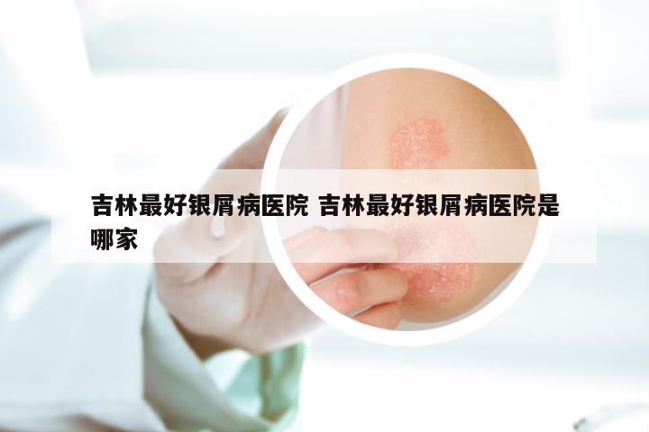 吉林最好银屑病医院 吉林最好银屑病医院是哪家