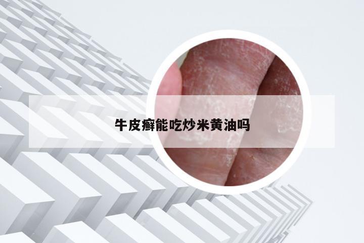 牛皮癣能吃炒米黄油吗