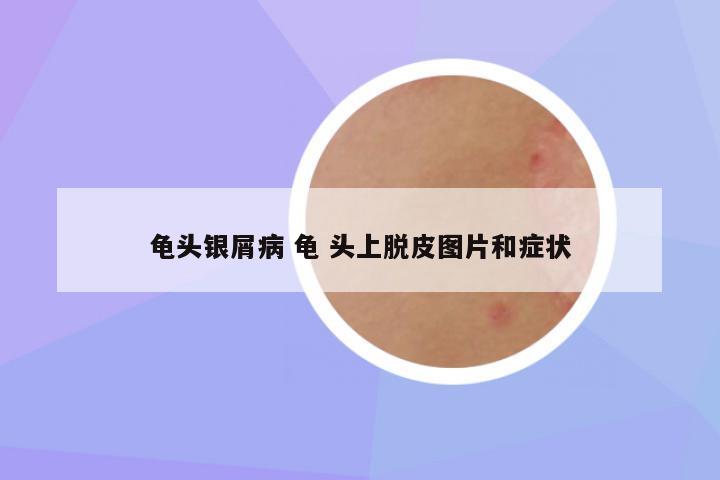 龟头银屑病 龟 头上脱皮图片和症状