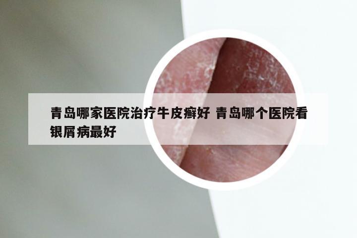 青岛哪家医院治疗牛皮癣好 青岛哪个医院看银屑病最好
