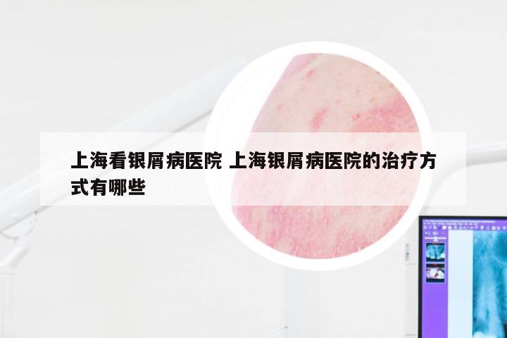 上海看银屑病医院 上海银屑病医院的治疗方式有哪些